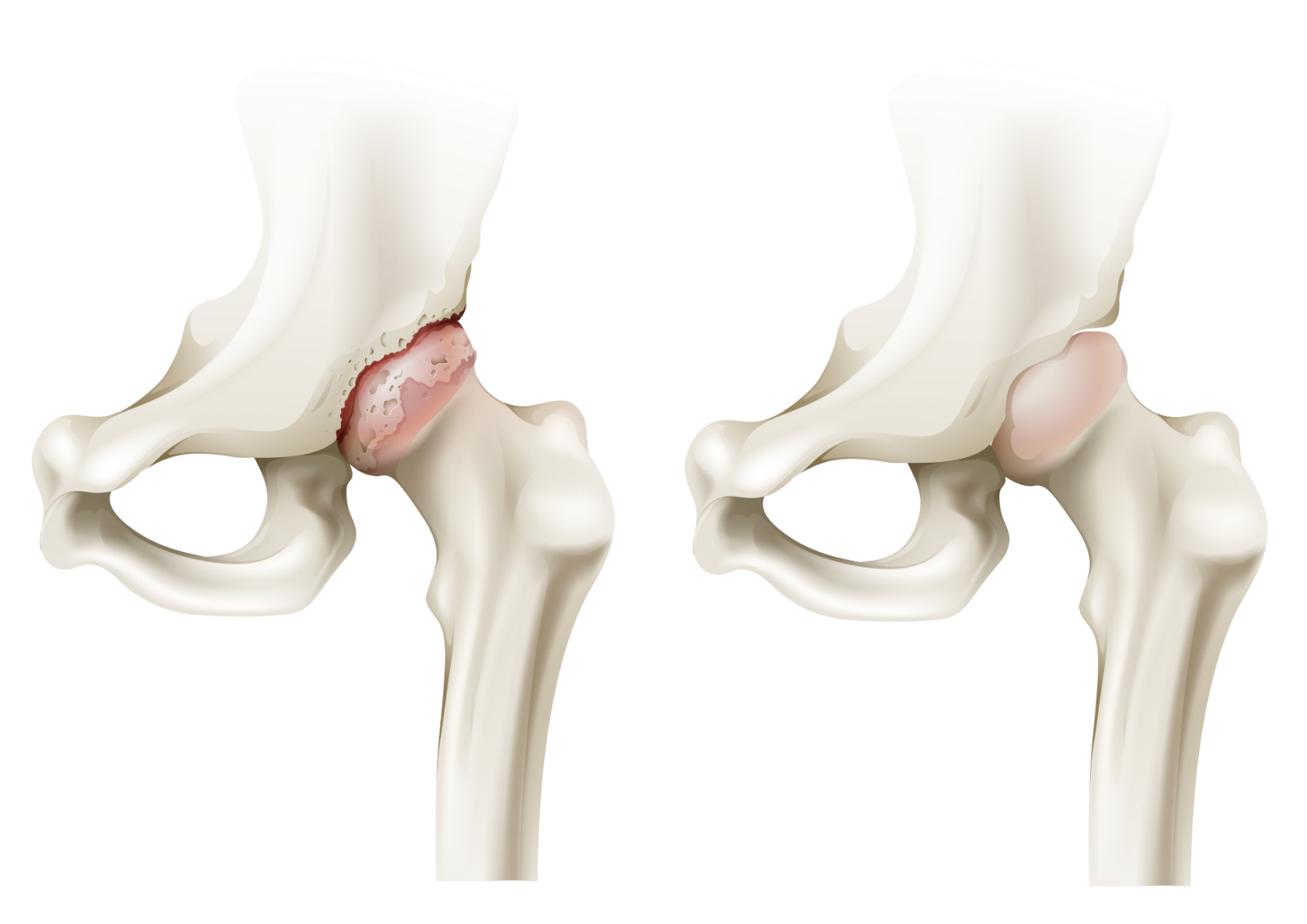 Артроз операция тазобедренного сустава. Артропатия тазобедренного сустава. Костный артрит тазобедренного сустава. Коксартроза тазобедренного сустава. Тазобедренный сустав анатомия артроз.